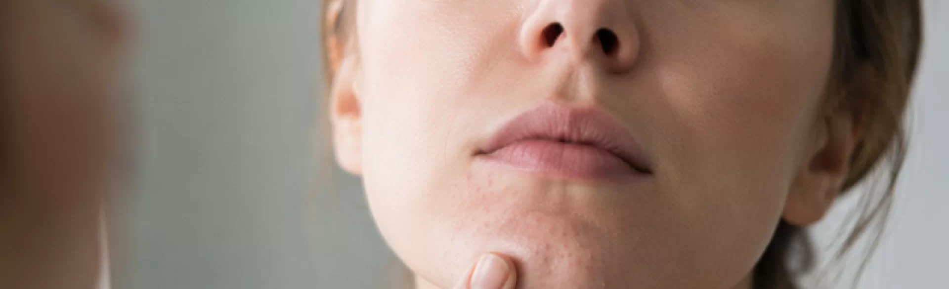 Blackheads on the chin