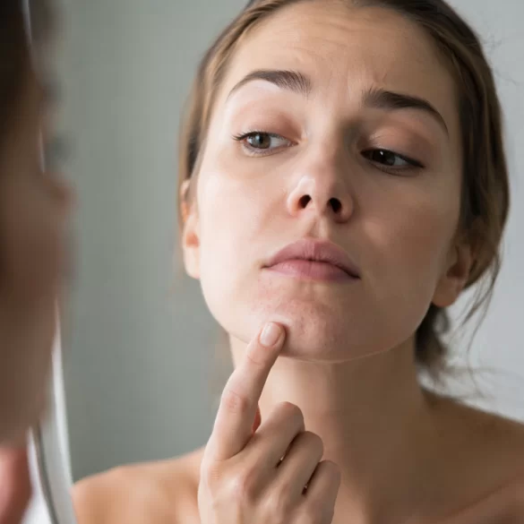 Blackheads on the chin