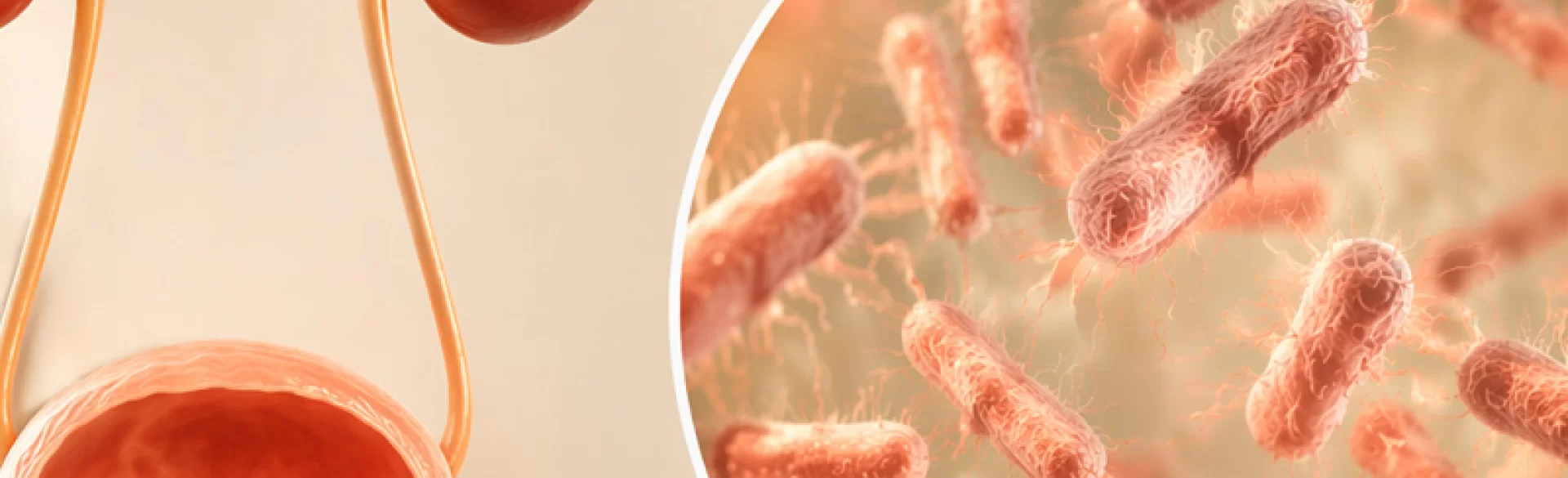 Urinary tract infection