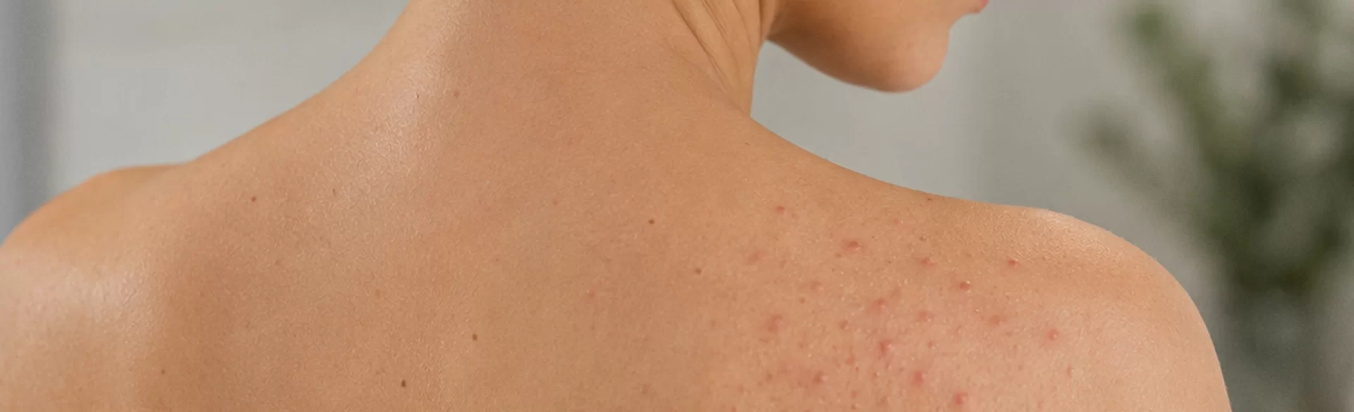 Folliculitis