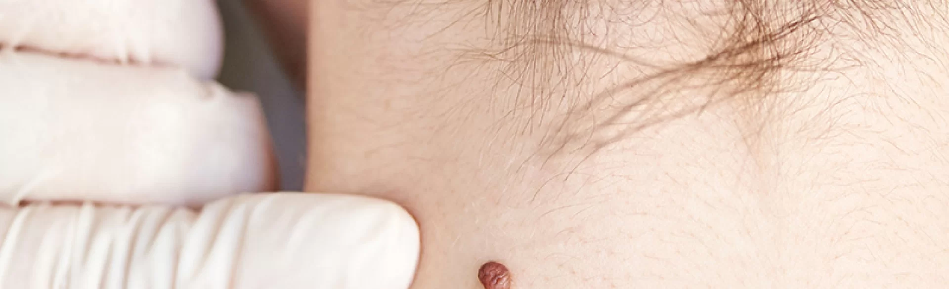 Atypical nevus