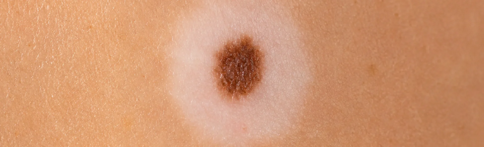 Halo nevus