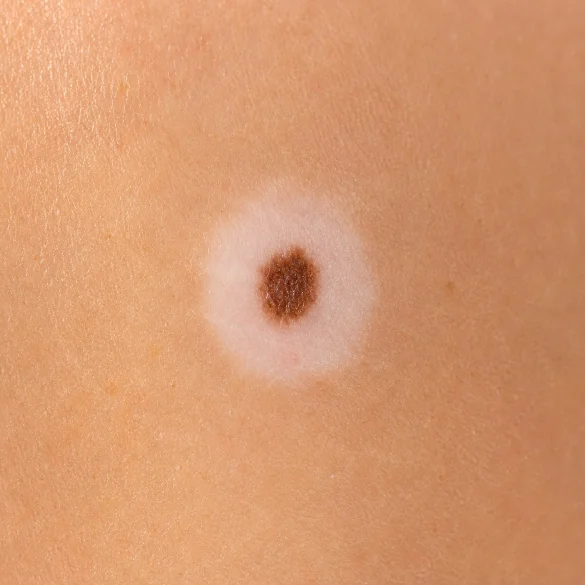 Halo nevus