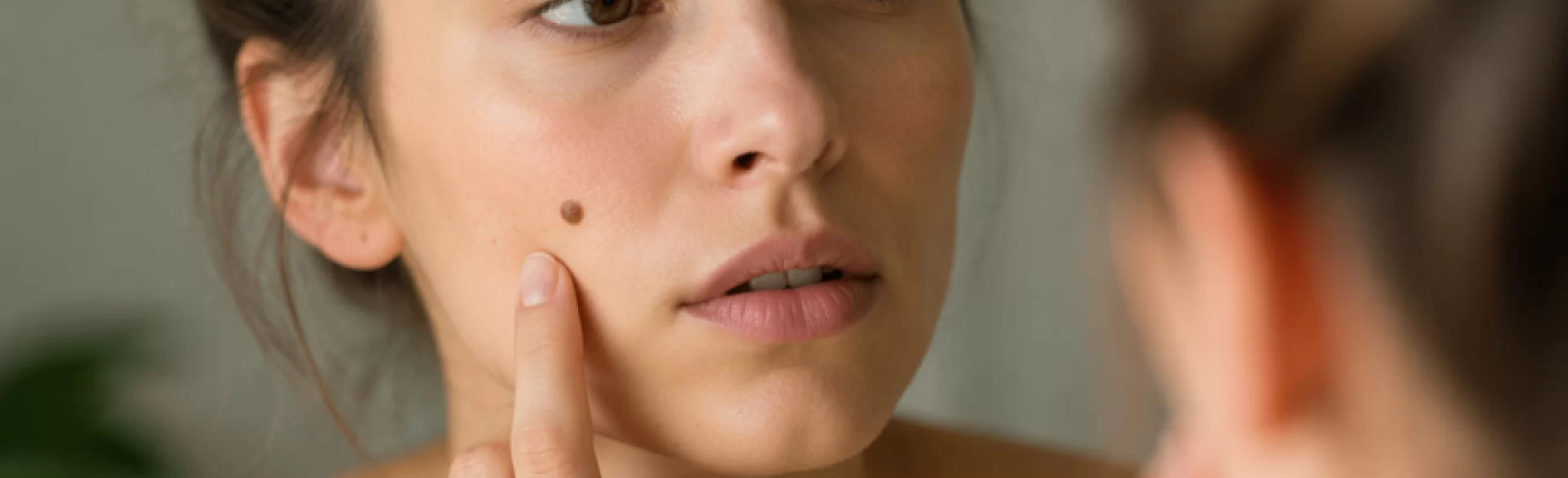 Birthmark on the face