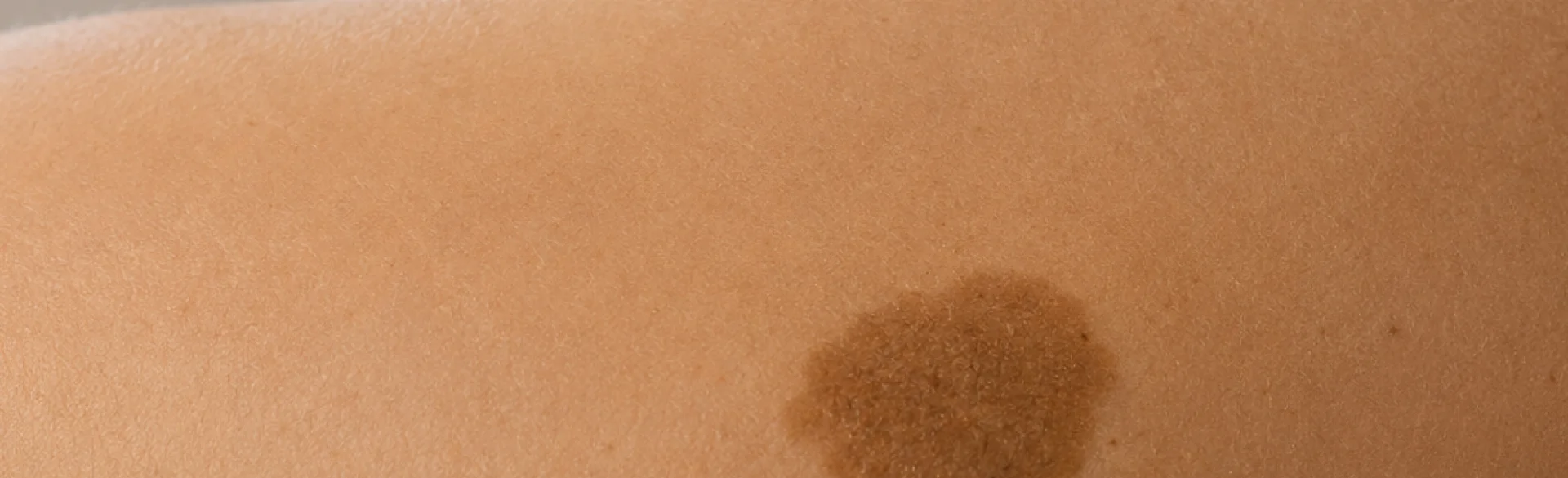 Congenital nevus