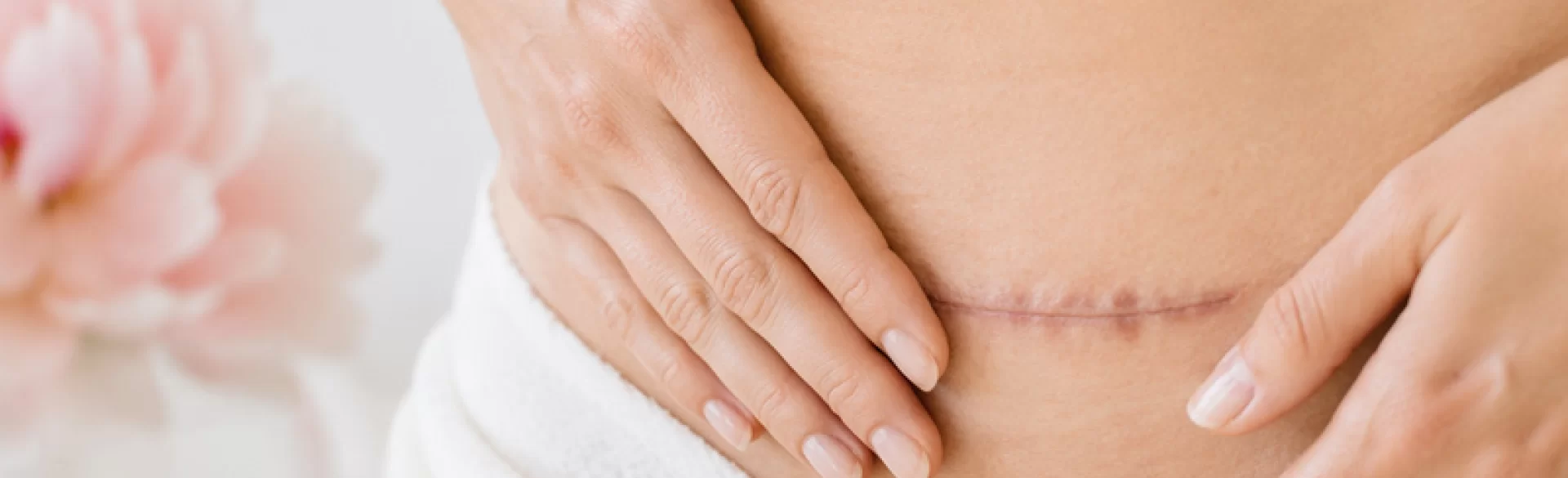 Adhesions after a cesarean section