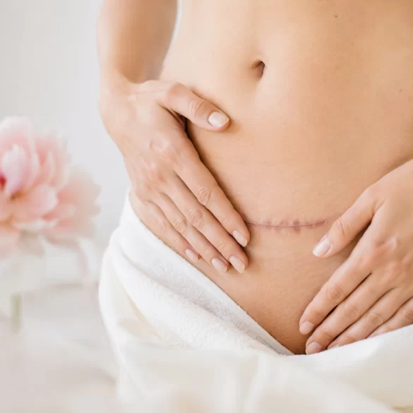 Adhesions after a cesarean section