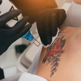 LASER TATTOO REMOVAL
