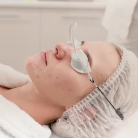 LASER ACNE TREATMENT