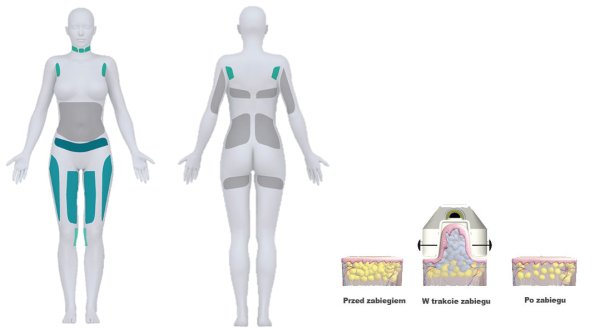 kriolipoliza-cooltech-obszary