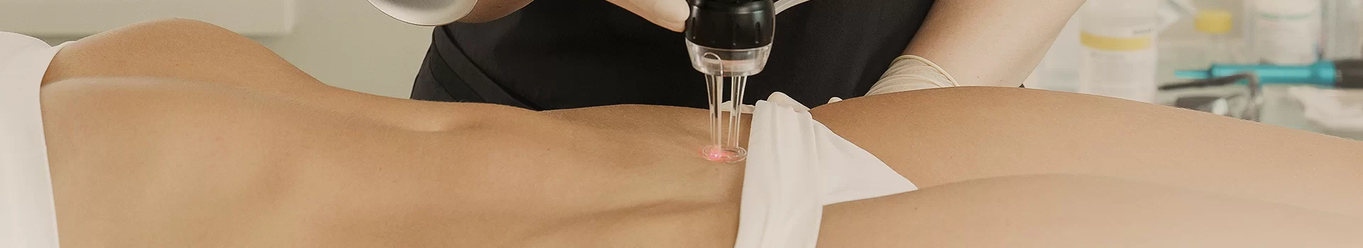 REMOVAL OF SCAR AFTER CESAREAN SECTION