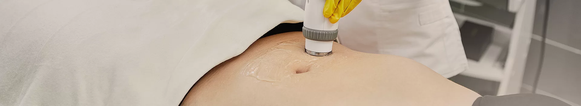 Treatments for stretch marks after pregnancy